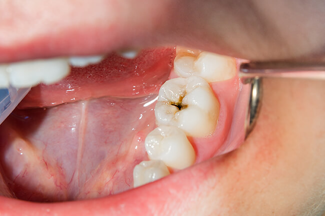 むし歯治療について