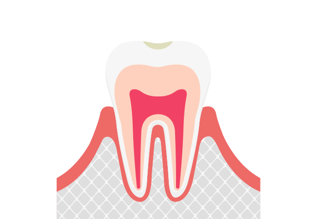 CO ごく初期のむし歯