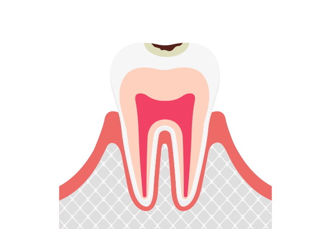 C1 エナメル質に小さな穴が空いたむし歯