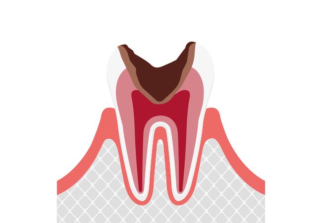 C3 神経まで進行したむし歯