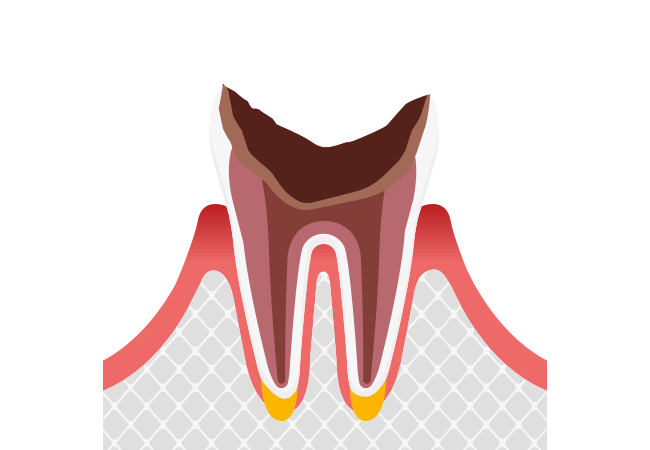 C4 歯根まで進行したむし歯