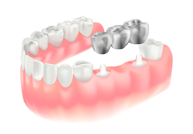 抜歯(歯の喪失)後の治療方法