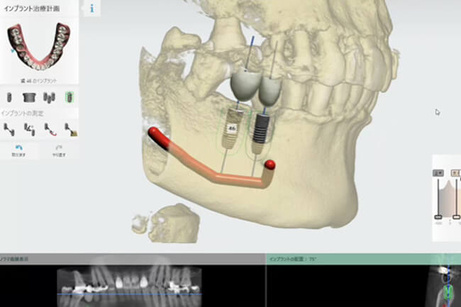全症例でサージカルガイドを使用した安全な手術02