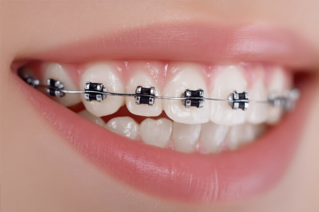 大人の矯正歯科について
