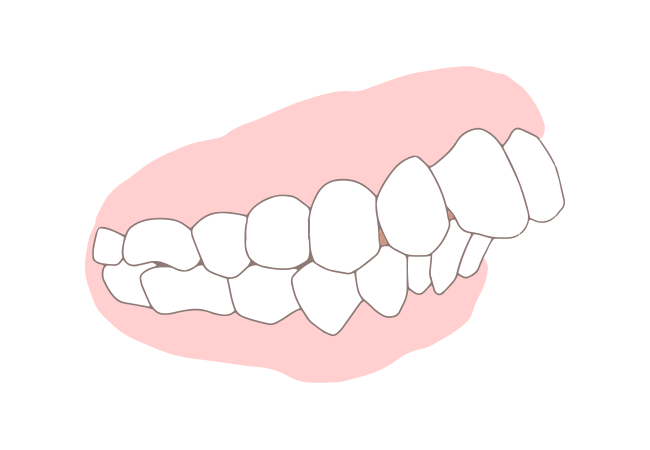 出っ歯(上顎前突)