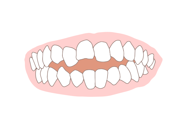 開咬(かいこう)