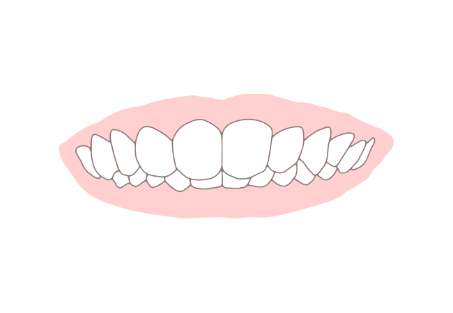 過蓋咬合(かがいこうごう)