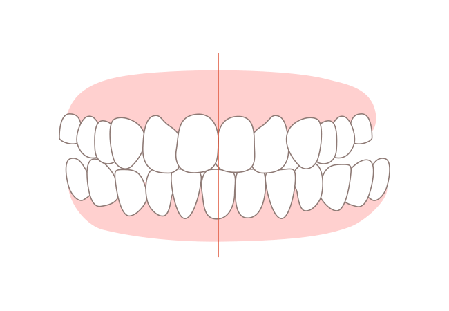 交叉咬合(こうさこうごう)