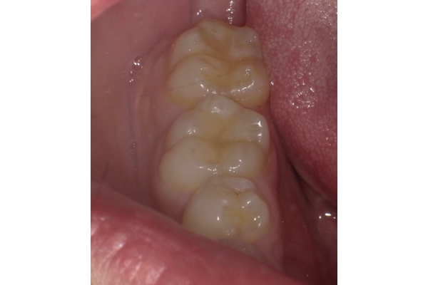 コンポジットレジン修復 after