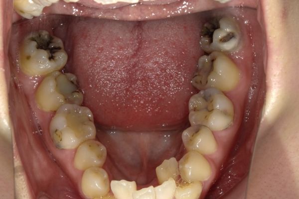 インレー治療 before