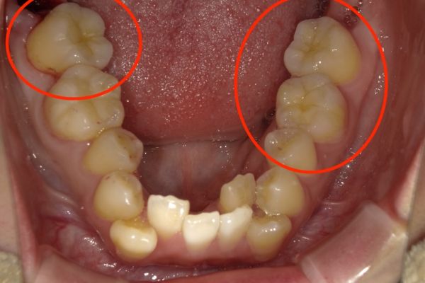 インレー治療 after