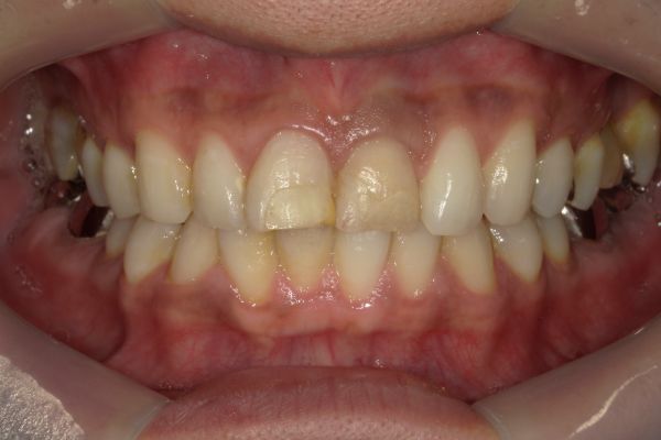 クラウン（被せ物）治療 before