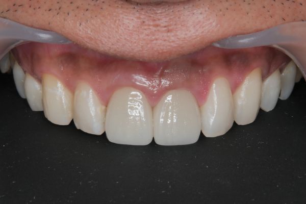 クラウン（被せ物）治療 after