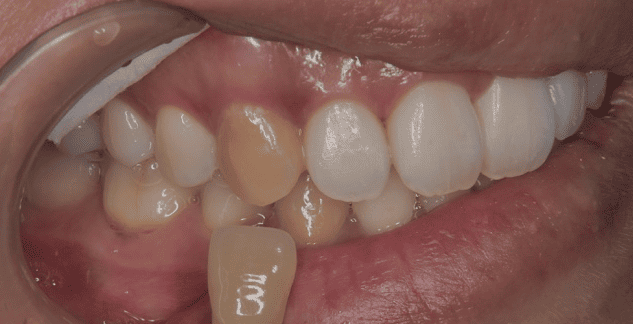 ホワイトニング before