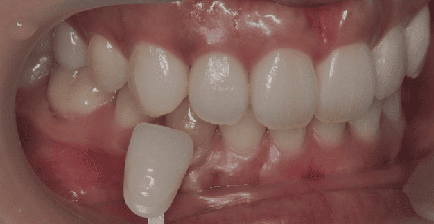 ホワイトニング after