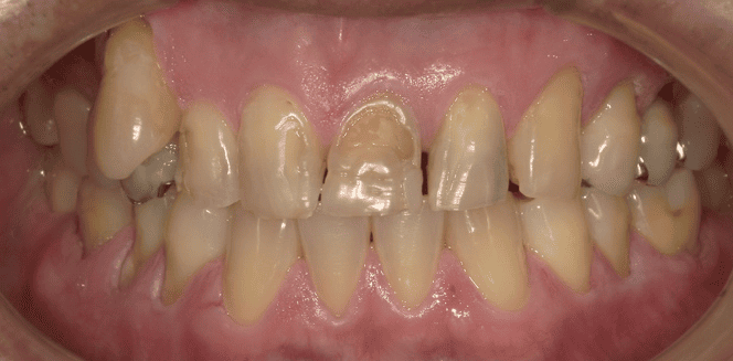 セラミック治療 before