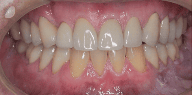 セラミック治療 after