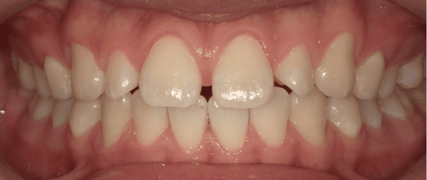 セラミック治療2 before