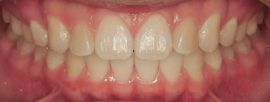 セラミック治療2 after
