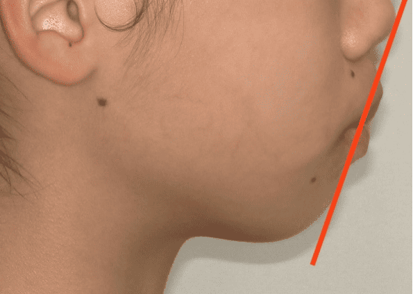 ワイヤー矯正でのEラインの変化 before