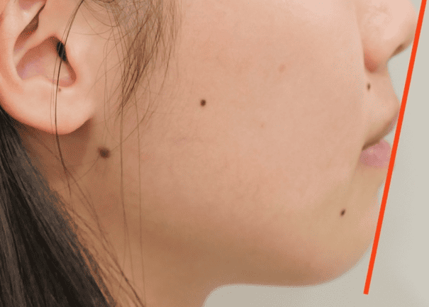 ワイヤー矯正でのEラインの変化 after